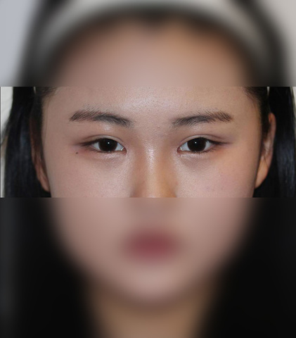 매몰 + 앞트임