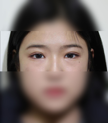 매몰 + 앞트임